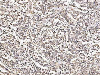 IHC staining of FFPE human pancreatic cancer tissue with AGT antibody. HIER: boil tissue sections in