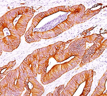 IHC staining of colon carcinoma with pan Cytokeratin antibody cocktail AE1 + AE3.