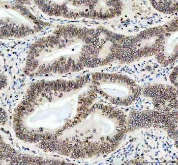IHC staining of FFPE human stomach cancer tissue with LMNB1 antibody. HIER: boil tissue sections in