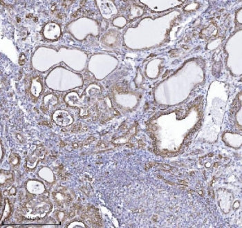IHC staining of FFPE human thyroid cancer tissue with DBN1 antibody. HIER: boil tissue sections in p