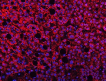 Immunofluorescent staining of FFPE human liver cancer tissue with TMPRSS13 antibody (red) and DAPI n