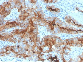 IHC staining of FFPE human thyroid carcinoma with recombinant Thyroglobulin antibody (clone rTGB/474