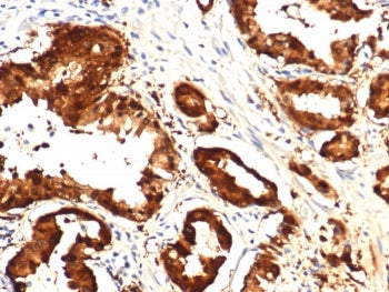IHC staining of FFPE human prostate tissue with IDH1-R132H mutation with IDH1-R132H Mutant antibody