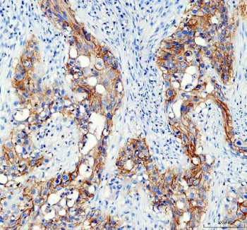IHC staining of FFPE human bladder cancer tissue with AQP3 antibody. HIER: boil tissue sections in pH8 EDTA for 20 min and allow to cool before testing.
