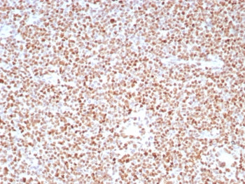 IHC staining of FFPE human colon carcinoma tissue with PMS2 antibody (clone PMS2/8224R). HIER: boil