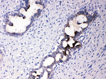 IHC testing of FFPE human breast cancer tissue with ATF6 antibody at 1ug/ml. Required HIER: steam se
