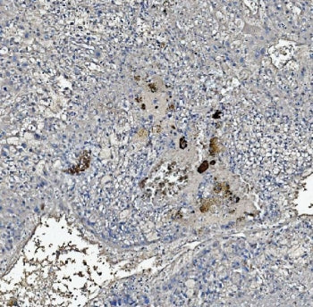 IHC staining of FFPE human liver cancer tissue with C Reactive Protein antibody. HIER: boil tissue s