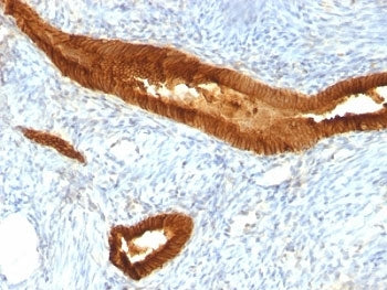 IHC: Formalin-fixed, paraffin-embedded human endometrial carcinoma stained with EpCAM antibody (MOC-