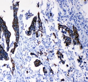 IHC staining of FFPE human intestinal cancer tissue with Cytokeratin 8 antibody. HIER: boil tissue s