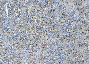 IHC staining of FFPE human testicular seminoma tissue with TMEM87A antibody. HIER: boil tissue secti