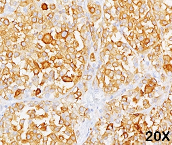 Formalin/paraffin human melanoma stained with MART-1 / Melan-A antibody (clone M2-9E3). Note cytopla