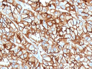 IHC staining of FFPE human renal cell carcinoma with CD10 antibody (clone CDLA10-1). Required HEIR: