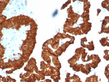 IHC staining of FFPE human kidney cancer with Crystallin Alpha B antibody (clone CRYAB/4661). HIER: