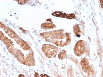 IHC staining of FFPE human breast carcinoma with CD135 antibody (clone FLT3/2458). HIER: boil tissue