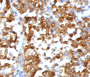 IHC testing of formalin-fixed, paraffin-embedded human melanoma stained with recombinant MART-1 anti