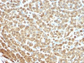 IHC testing of FFPE human melanoma stained with S100A1 antibody (clone S1-61). Required HIER: boil t