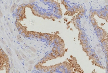 IHC staining of FFPE human prostate carcinoma tissue with recombinant Thymidylate Synthase antibody