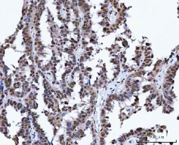 IHC staining of FFPE human ovarian cancer tissue with X-ray repair cross-complementing 4 antibody. H