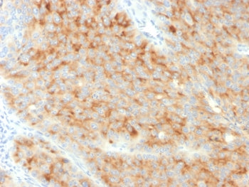 IHC staining of FFPE human pancreatic carcinoma with Synaptophysin antibody (clone SYP/3551). HIER: