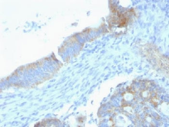 IHC: Formalin-fixed, paraffin-embedded human testicular carcinoma stained with anti-Perlecan antibod