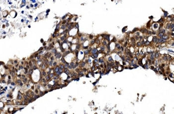 IHC staining of FFPE human pancreatic cancer with TBP-1 antibody. HIER: boil tissue sections in pH8