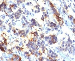 IHC testing of FFPE human gastric carcinoma with MUC5AC antibody (clone MUCN5AC). Staining of formal