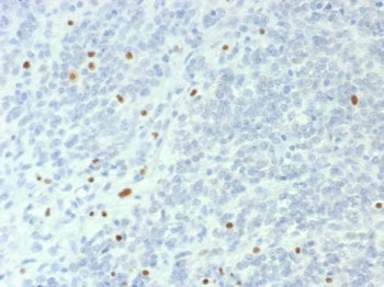 IHC staining of FFPE human ovarian small cell carcinoma with SMARCA4 antibody (clone BRG1/6531R). HI