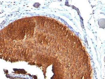 IHC: Formalin-fixed, paraffin-embedded human bladder carcinoma stained with Cytokeratin 19 antibody