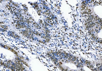 IHC staining of FFPE human rectal cancer tissue with TLS antibody. HIER: boil tissue sections in pH8