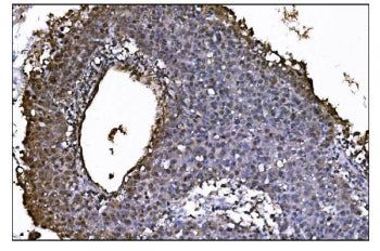IHC staining of FFPE human liver cancer tissue with COPS5 antibody. HIER: boil tissue sections in pH