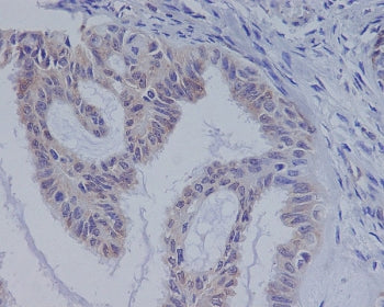 IHC staining of FFPE human ovarian cancer with BRAF antibody. HIER: boil tissue sections in pH6, 10m