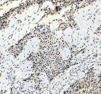 IHC staining of FFPE human lung cancer tissue with ATRIP antibody, HRP-secondary and DAB substrate.