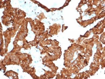 IHC staining of FFPE human kidney cancer with Crystallin Alpha B antibody (clone CRYAB/4657). HIER: