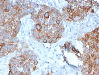 IHC staining of FFPE human prostate carcinoma with STAT2 antibody. HIER: boil tissue sections in pH