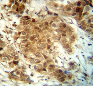 FOXO3 antibody immunohistochemistry analysis in formalin fixed and paraffin embedded human breast ca