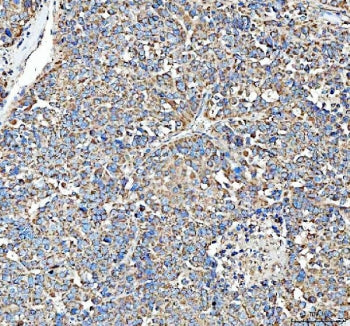 IHC staining of FFPE human liver cancer tissue with HSD11B1 antibody. HIER: boil tissue sections in