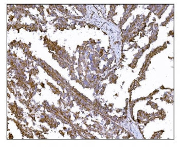 IHC staining of FFPE human ovarian cancer tissue with LRP1B antibody. HIER: boil tissue sections in