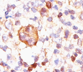IHC testing of Hodgkin's lymphoma stained with Bcl-X antibody (BX006). Note cytoplasmic and membrane
