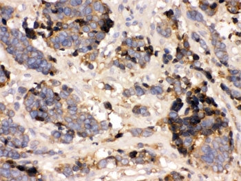 IHC testing of FFPE human lung cancer tissue with Transthyretin antibody. HIER: Boil the paraffin se