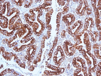 IHC testing of FFPE human gastric carcinoma with MUC5AC antibody (clone CLH2). Required HIER: steam