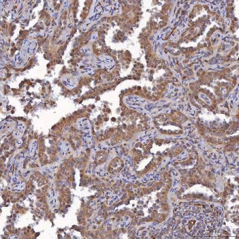 IHC staining of FFPE human lung cancer tissue with SAV1 antibody. HIER: boil tissue sections in pH8