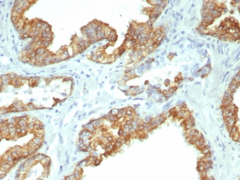 IHC staining of FFPE human prostate cancer tissue with recombinant CK19 antibody (clone KRT19/8091R)