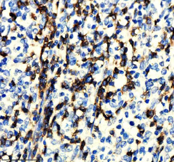 IHC staining of FFPE human lymphoma tissue with CD247 antibody, HRP-secondary and DAB substrate. HIER: boil tissue sections in pH8 EDTA for 20 min and allow to cool before testing.