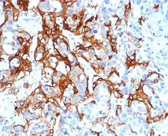 IHC staining of FFPE human colorectal liver metastasis with recombinant TROP2 antibody (clone TACSTD