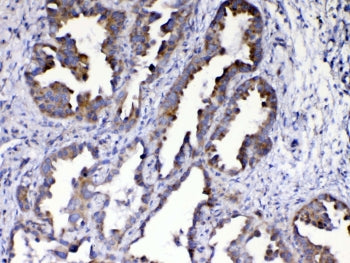 IHC testing of FFPE human lung cancer tissue with AMD1 antibody at 1ug/ml. Required HIER: steam sect