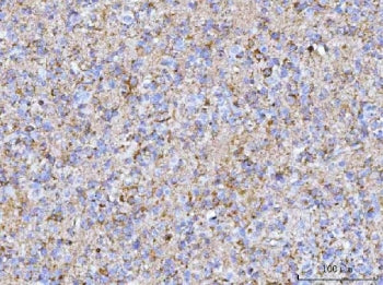 IHC staining of FFPE human glioma tissue with HBBM antibody. HIER: boil tissue sections in pH8 EDTA