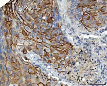 IHC staining of FFPE human lung squamous cell carcinoma tissue with S100A14 antibody. HIER: boil tis