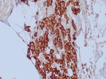 IHC staining of FFPE human mesothelioma tissue with Mesothelial Cell antibody (clone HBME-1). HIER:
