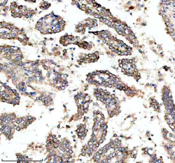 IHC staining of FFPE human lung cancer tissue with MYO7A antibody, HRP-secondary and DAB substrate.