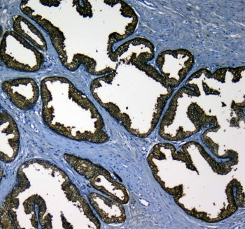 IHC testing of FFPE human prostate cancer tissue with KLK2 antibody at 1ug/ml. Required HIER: steam